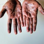 The Department of Health confirmed that one person has died from the Mpox virus. File Picture