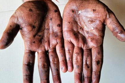 The Department of Health confirmed that one person has died from the Mpox virus. File Picture