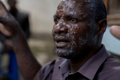 Jean Kakuru Biyambo, from the Muja internally displaced persons camp, is seen at the Goma General Hospital where he has been receiving treatment against mpox in North Kivu province, Democratic Republic of Congo [Arlette Bashizi/Reuters]