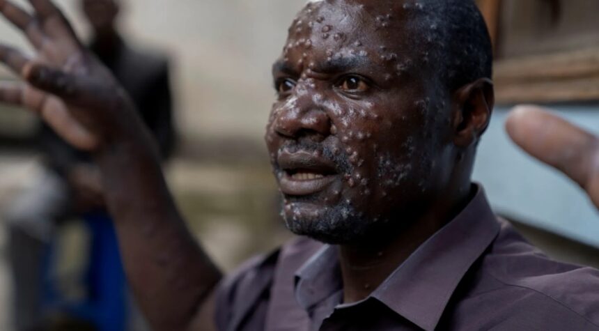 Jean Kakuru Biyambo, from the Muja internally displaced persons camp, is seen at the Goma General Hospital where he has been receiving treatment against mpox in North Kivu province, Democratic Republic of Congo [Arlette Bashizi/Reuters]
